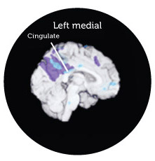 left medial Pattern of DCGM in young men, E4 carriers and patients with probable Alzheimer's disease