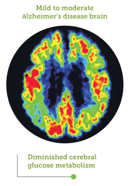 Area of cerebral glucose metabolism in Alzheimer's disease, comparison