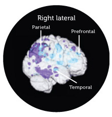 right lateral Pattern of DCGM in young men, E4 carriers and patients with probable Alzheimer's disease